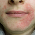 Perioral dermatit (POD): symtom, orsaker & behandling